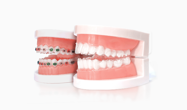 Clear aligners and metal braces demo models representing treatment customization