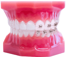 Invisible Braces compare Metal Braces In Teeth Mould Visual