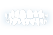 CROWDED TEETH