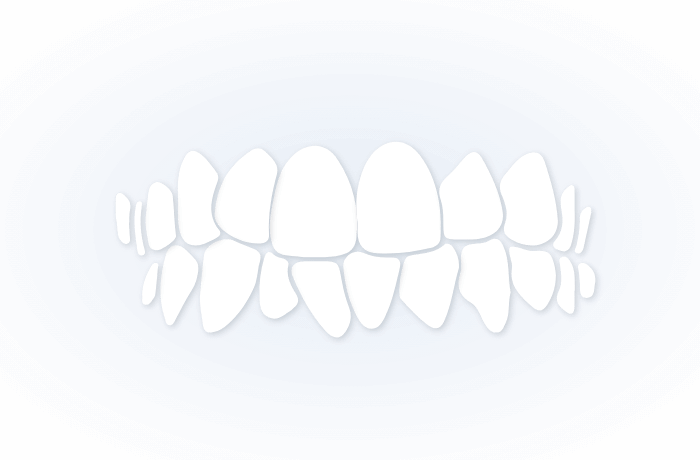 CROSSBITE