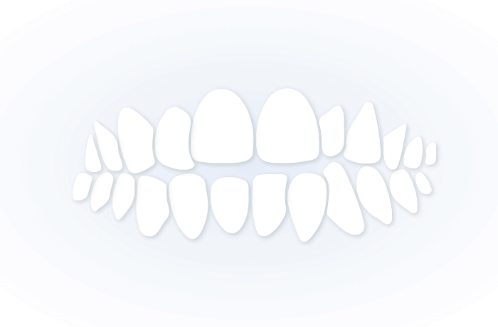 OPEN BITE