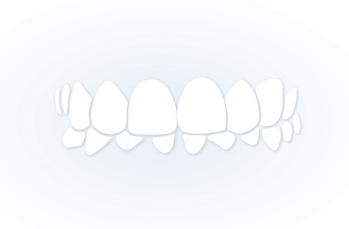 OVERBITE