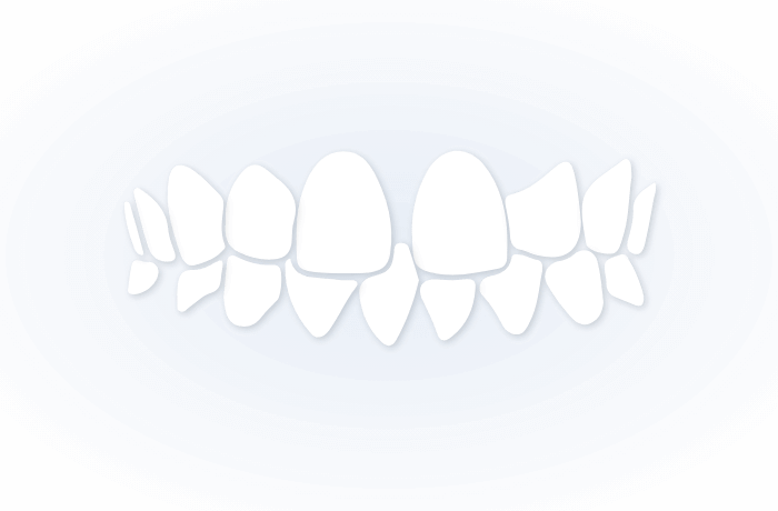 TEETH GAP