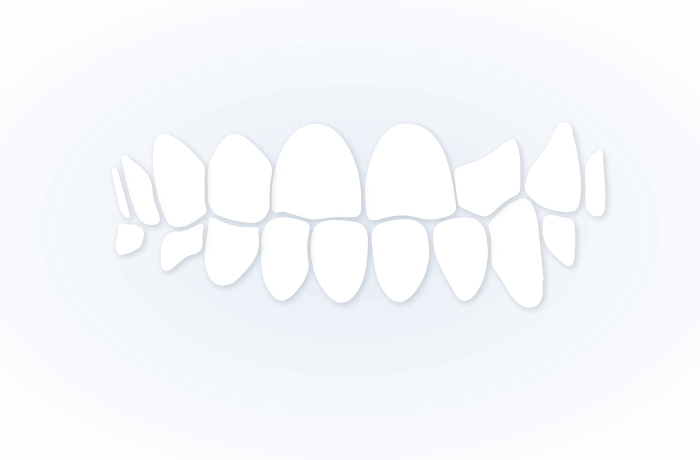 UNDERBITE