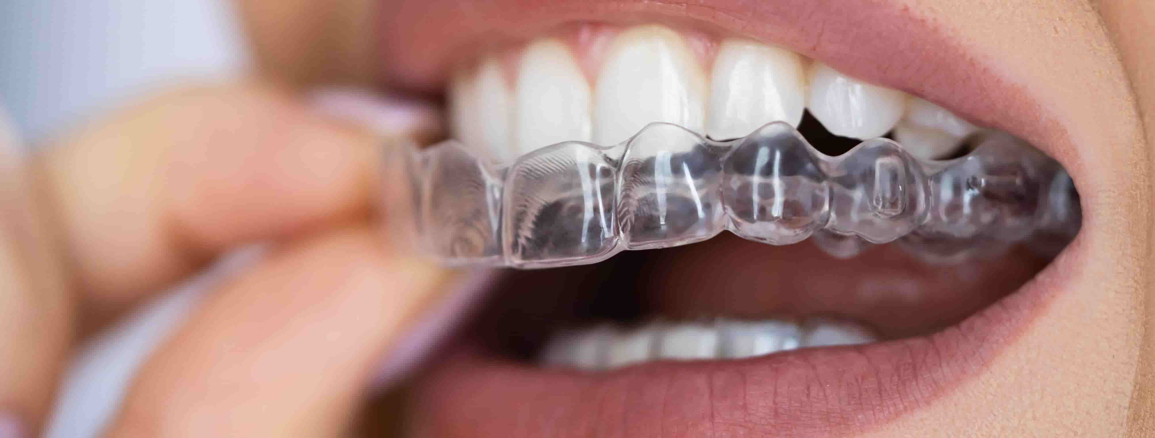 Clear aligners used for discreet teeth straightening in Australia