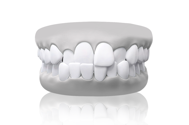 malocclusion crossbite