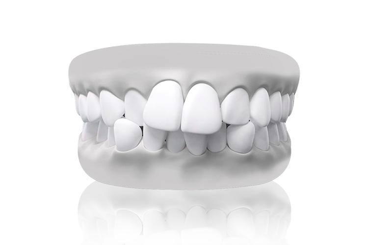 malocclusion crowded