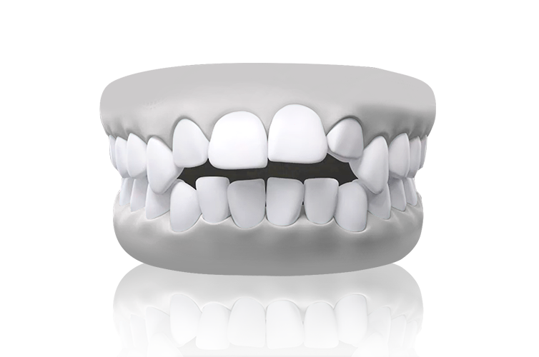malocclusion openbite