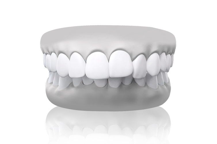 malocclusion overbite