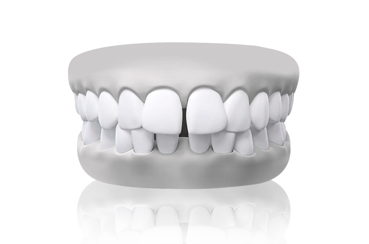 malocclusion spacing teethgap